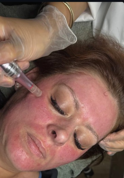 Apparatives Microneedling — Präzise Wirkstoffinfusion für strahlenden Teint